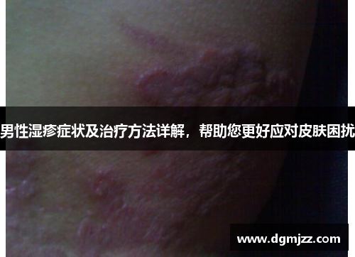 男性湿疹症状及治疗方法详解，帮助您更好应对皮肤困扰